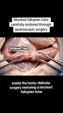 Blocked fallopian tube carefully restored #fyp #surgery #health #fertility #laparoscopy