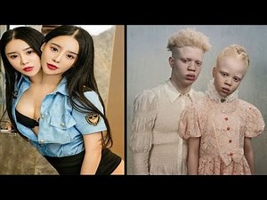 15 Most Unusual Twins In The World