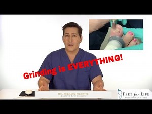 Fungal Nail Grinding Is Everything part 2 / 3.