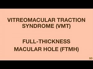Retina: Session 48: Vitreomacular Traction (VMT) and Full-Thickness Macular Hole (FTMH)