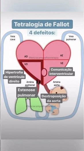Tetralogia de Fallot: resumo das alterações.
