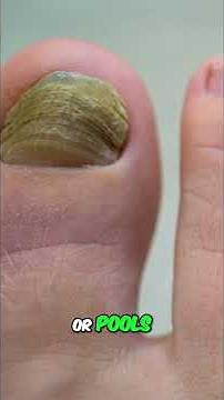 How to Avoid Fungal Infections