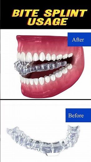 "What’s a Bite Splint? The Dental Secret to Stop Night Grinding!