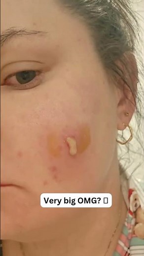 Large Blackheads Extraction Big Cystic Acne Blackheads&Whiteheads Removal Pimple Popping #1025 2026