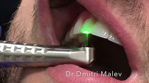 Laser Crown Removal