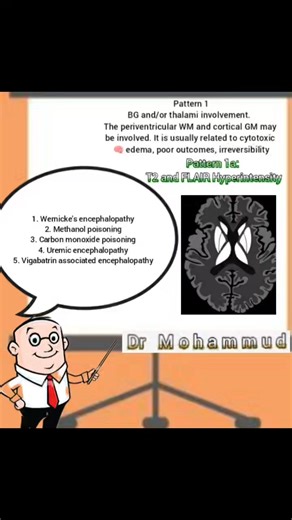 21 Posts about #toxic_metabolic_encephalopathy Each one containers 🫙 Etiology Clinical features Radiological signs Treatment 1️⃣ Wernicke's encephalopathy https://m.facebook.com/story.php?story_fbid=832001682499736&id=100070697355985&mibextid=Nif5oz 2️⃣ Methanol poisoning https://m.facebook.com/story.php?story_fbid=832047512495153&id=100070697355985&mibextid=Nif5oz 3️⃣ Carbon monoxide poisoning https://www.facebook.com/share/p/16Mfd3tw1n/ 4️⃣ Vigabatrine associated toxicity https://www.facebook