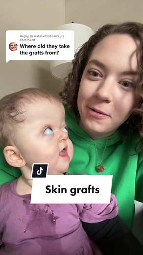 Understanding Apert Syndrome: Skin Grafts and Syndactyly Release