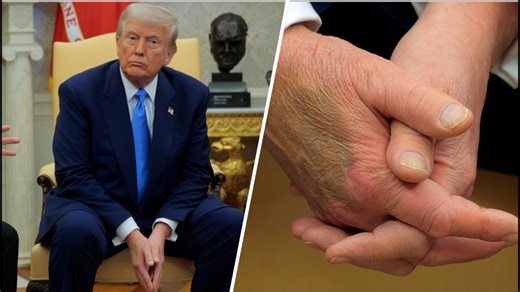 Trump diagnosed with chronic venous insufficiency