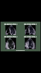 19K views · 173 reactions | How measure Ejection Fraction with...