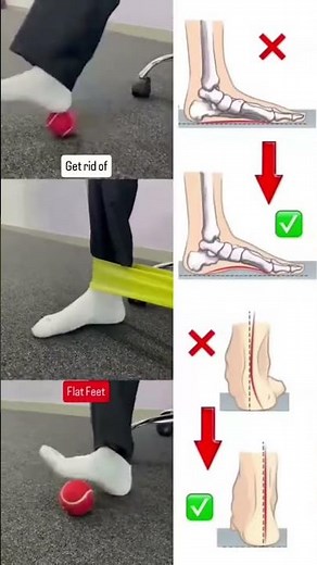Flat foot #youtube #viral