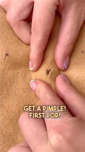 Would you pop this or is it too gross? 🤢 #pimplepopping