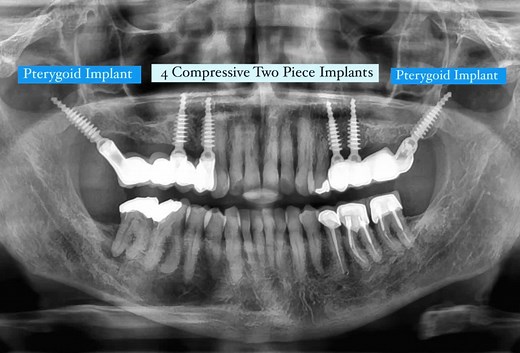 ‏Rehabilitation for a patient missing teeth 14, 15, 16, 17, 18, 24, 25, 26, 27, and 28 with severe bone loss. The treatment uses 2 compressive two piece implants and 2 pterygoid implants, without sinus lift or bone grafting. Immediate loading with screws Rehabilitation Dr.Samara