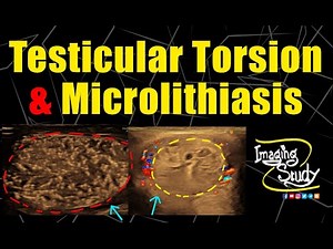 Testicular Early Subacute Torsion & Diffuse Microlithiasis || Ultrasound || Case 323