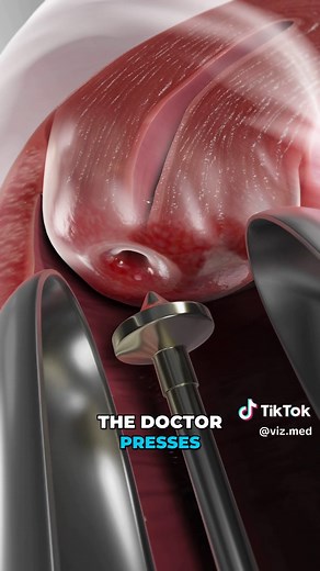 Cervical Cryosurgery: A Key to Preventing Cervical Cancer