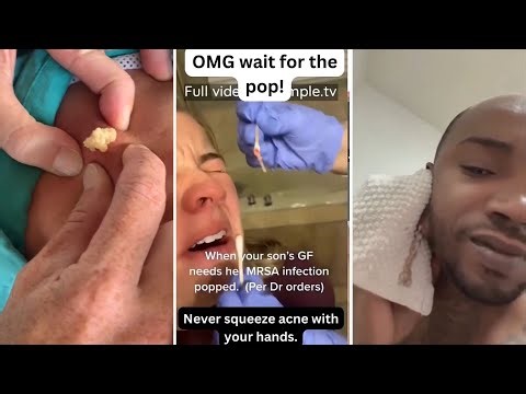 Best Satisfying Pimples Popping Cyst Removal Acne Blackheads Compilation Videos #26