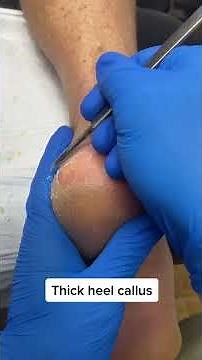 Say goodbye to dry, cracked heels with this easy-to-follow callus removal guide!