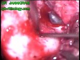 Subperiosteal Abscess • Video • MEDtube.net