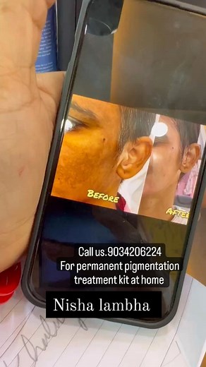 3.3K views · 11 reactions | Call us.9034206224 for order online your personal pigmentation treatment kit at home @nisha_lambha @nisha_lambha_official_ @khaliyat_ #trendingreels #trend #treatment #trending #tbt #video #viral #explore #explorepage #reels #reelsinstagram #instagram #instagood #fyp #facetreatment #facial | Nisha Lambha - Sparsh Beauty Care & Hair Treatment LLP 5 | Facebook