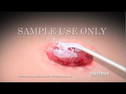 Úlceras por presión