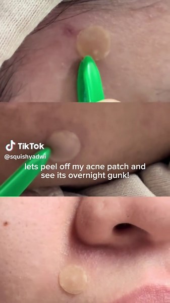 Pimple Patch Removal: Overnight Gunk Transformation