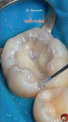 Step-by-Step: How Dentists Remove CAVITIES (Fast!) 🦷⚙️