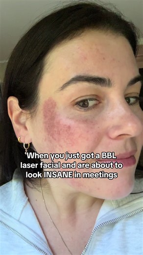 Transform Your Skin with BBL Laser Facial Treatment