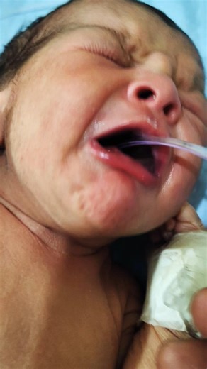 NG Tube Insertion and Newborns & NICU Babies | Nursing Skills #NGTubeInsertion