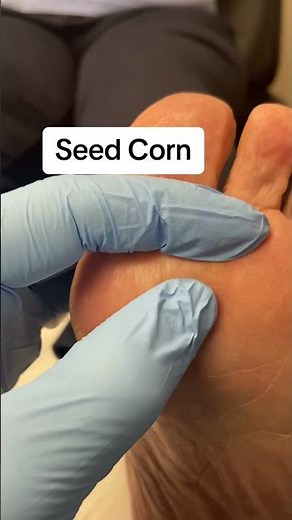 Podiatrist's Guide: Removing Painful Foot Corns! #Podiatry #FootCare