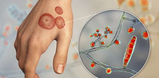 Ringworm fungal infections are common in the US and are becoming increasingly resistant to treatment – 6 questions answered