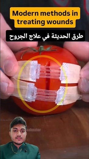 zip stitching #woundcare #skincuts #suture