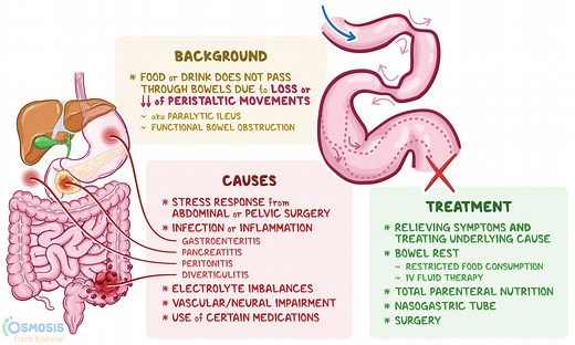 Adynamic Ileus: What Is It, Symptoms, Treatment, and More | Osmosis