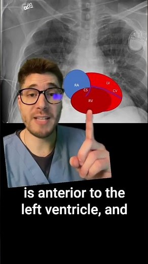 Pacemakers vs. ICDs on Xrays 🩻🫀