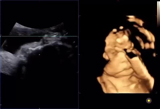 Our little bean passed the big test — no anomalies, no defects, just pure perfection in the making. ✨💫 So thankful 🙏 for this blessing growing inside me! #CAS #blessed #babyboy 👶 | Elaine Almuete Quiambao