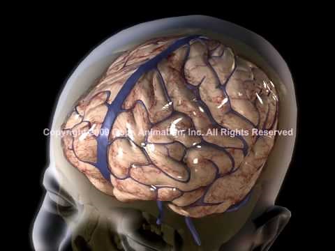 Shaken baby Syndrome 3D