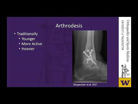 Revision Total Ankle Replacement A Rarity On The Rise