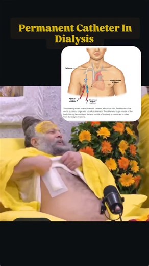 DIALYSIS_DISCOVERY | PERMANENT CATHETER IN DIALYSIS 💛 #dialysis#nephrology#dialysistechnician #premanandjimaharaj#premanandjimaharaj❤️... | Instagram