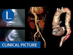 Leg weakness and paraesthesia provides a clue to sudden death