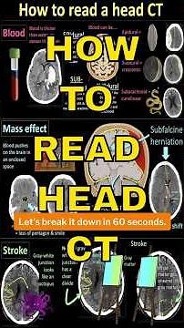 How to read a head CT