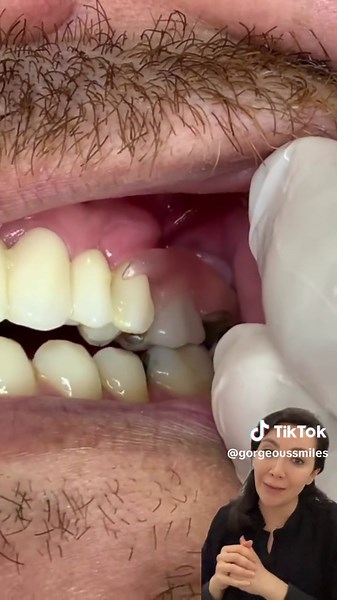 Replacing a Missing Tooth: Dental Bridge vs. Denture vs. Implant