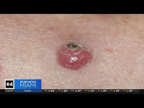 What is Merkel cell cancer?