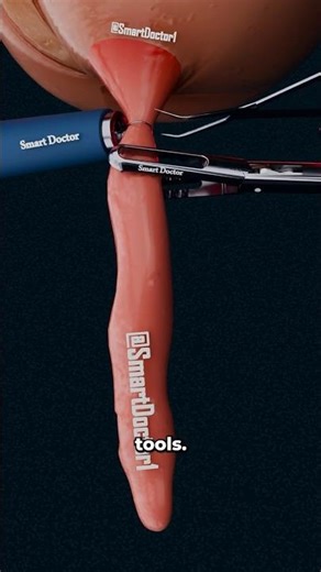 Why You Should Never Ignore Appendicitis ⚠️