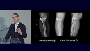 Bicondylar Tibia Plateau Fractures: When Is More Than One Approach Needed?