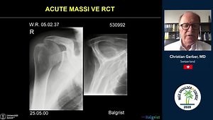 My Definition & Management of the Pseudoparalyzed Shoulder