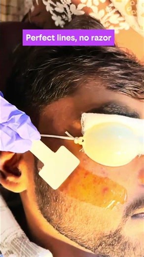 Laser Beard Shaping for Sharp Jawline | Precision Beard Sculpting at Sitai Multispecialty Clinic