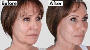 Linda Lusardi shows off the results of her nonsurgical facelift