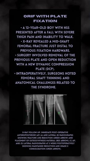 Peri-implant Femoral Fracture