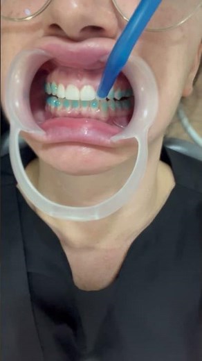 Así se colocan los ATACHES de ortodoncia invisible.