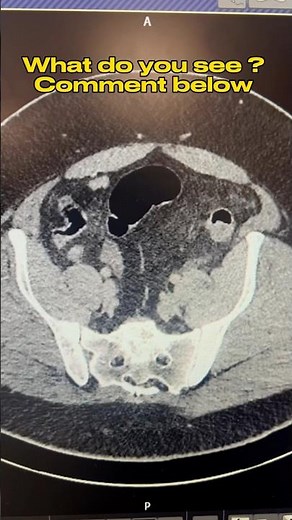 CT Scan Perforated Diverticulitis #ctscan #diverticulitis #surgery