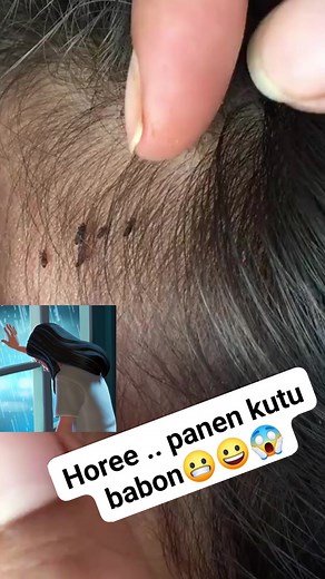 Lice removal 486 😊 #reels #kutu #lice #tumo | Susi Siram