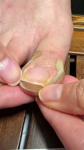 “Satisfying Skin Fix 😌”“Tiny Problem, Big Relief!”“Clean & Fresh Vibes 💅”“Oddly Satisfying Moment ✨